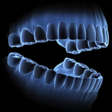 Digital-Dentures-3D-scanning-intraoral-225x225