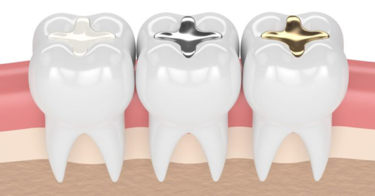Restorations-fillings-768x402-1